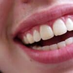 Tooth bonding - Dental Touch Associates - Cedar Rapids