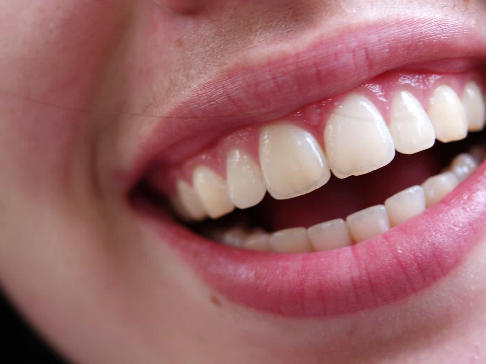 Tooth bonding - Dental Touch Associates - Cedar Rapids