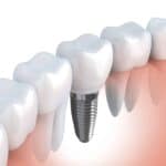 Dental Touch Associates uses dental implants to replace missing teeth - Cedar Rapids, IA - Dental Touch Associates