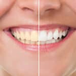 teeth whitening-at home or in your dentist's office. Contact Dental Touch Associates Cedar Rapids-Marion, IA.