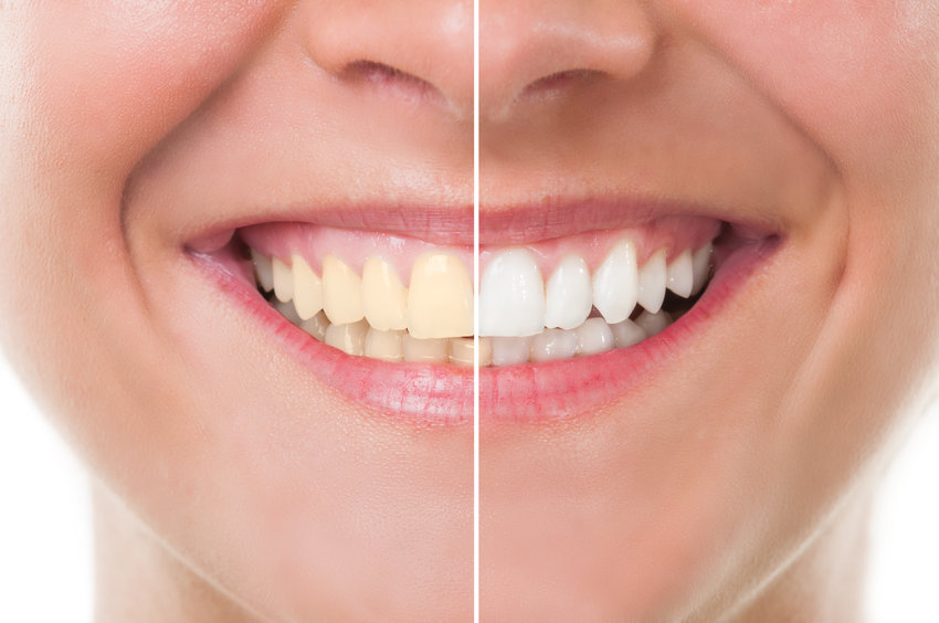 teeth whitening-at home or in your dentist's office. Contact Dental Touch Associates Cedar Rapids-Marion, IA.