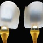 veneers-lumineers-Dental Touch-Cedar Rapids IA