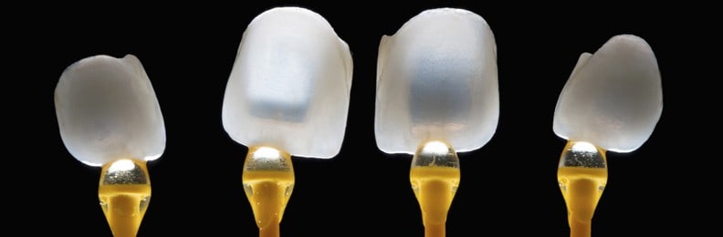 veneers-lumineers-Dental Touch-Cedar Rapids IA