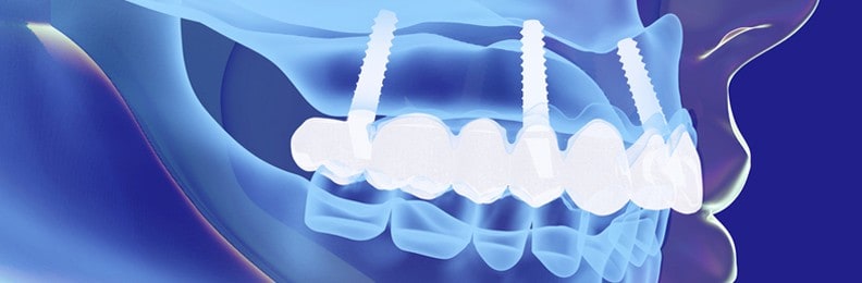3-d dental imaging-Dental Touch-Cedar Rapids IA